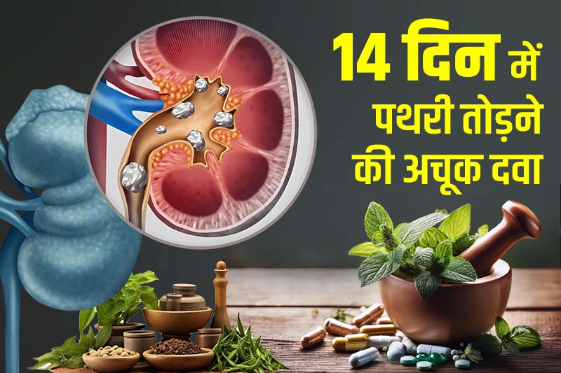 14 दिन में पथरी तोड़ने की अचूक दवा