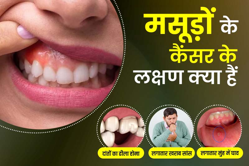 मसूड़ों के कैंसर के लक्षण क्या हैं