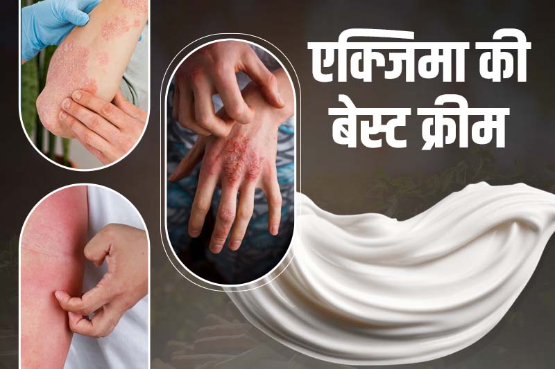 एक्जिमा की बेस्ट क्रीम