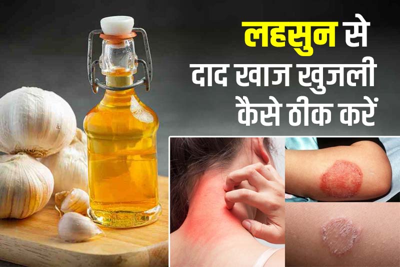 लहसुन से दाद खाज खुजली कैसे ठीक करें